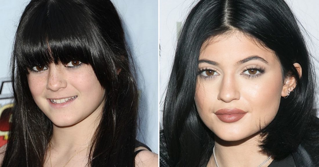 Kylie Jenner’s Lips And Nose Job; Before And After Surgery
