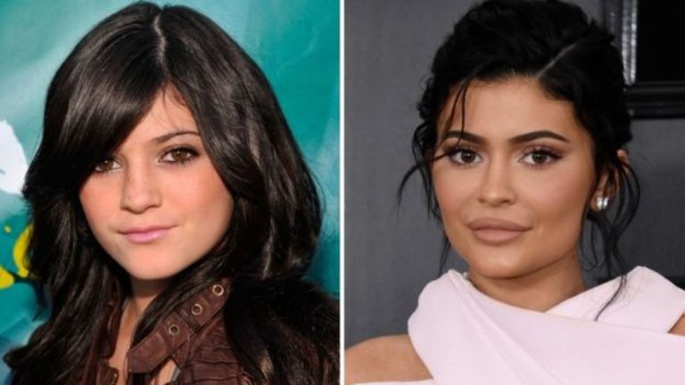 Kylie Jenner’s Lips And Nose Job; Before And After Surgery