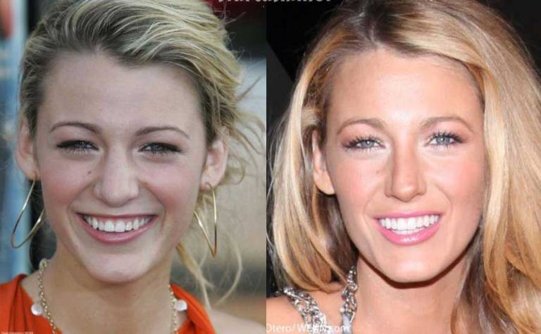 Blake Lively Nose Job: How She Changed After Plastic Surgery