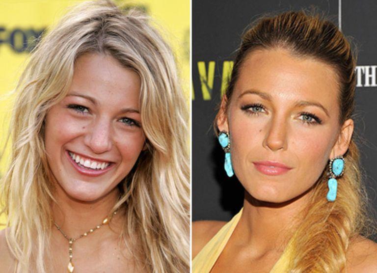 Blake Lively Nose Job: How She Changed After Plastic Surgery
